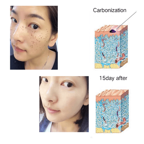 Mole Tattoo removal pen High-end design FY-103