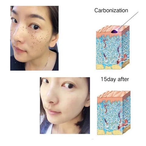 Mole Tattoo removal pen High-end design FY-103